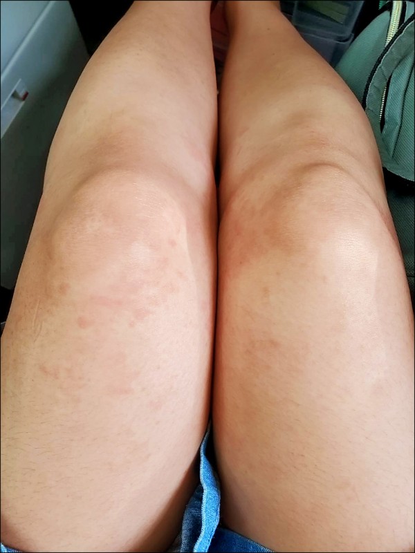 ▲服用中藥一週後,膝關節附近紅疹消退8成左右。(照片提供/周瑋玲) ▲服用中藥一週後,膝關節附近紅疹消退8成左右。(照片提供/周瑋玲)