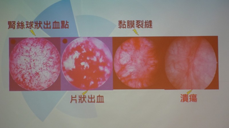 出血性膀胱炎の診断
