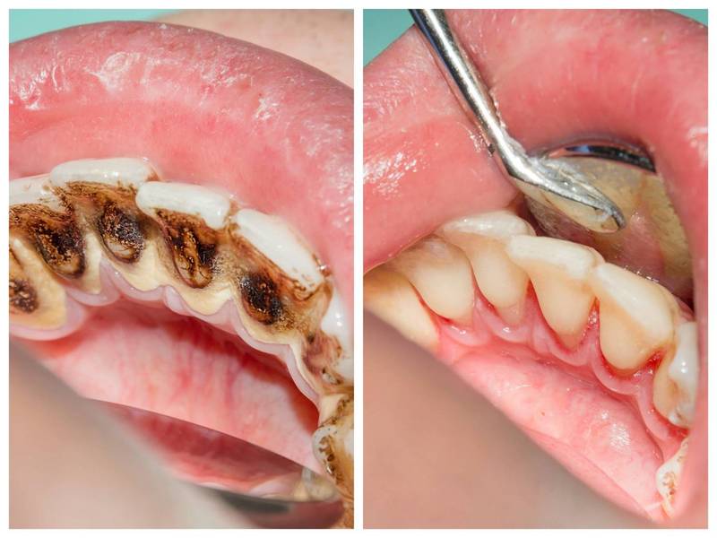 健康網 洗牙會傷牙 牙醫 只能破壞牙結石 即時新聞 自由健康網