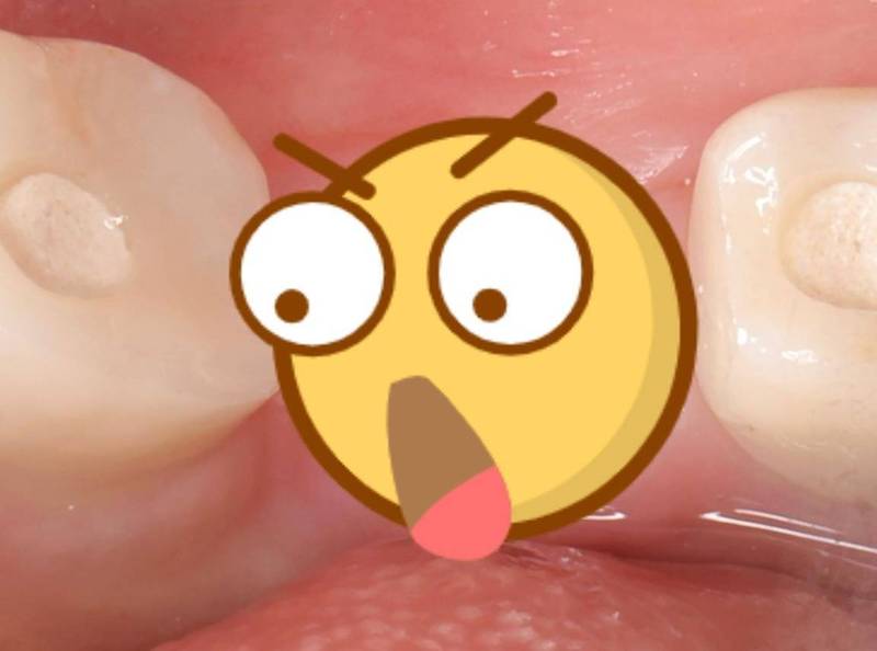 健康網》「牙周」到底是什麼？ 牙醫師直接拿出照片畫線說明 - 即時新聞