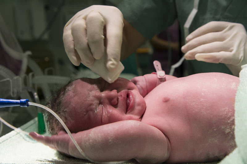 健康網》全球首例！3月大男嬰天生3根陰莖 醫評估後果斷切除 - 即時新聞