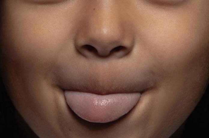 4-5％新生兒舌繫帶過緊 進食、構音、社交都可能受影響