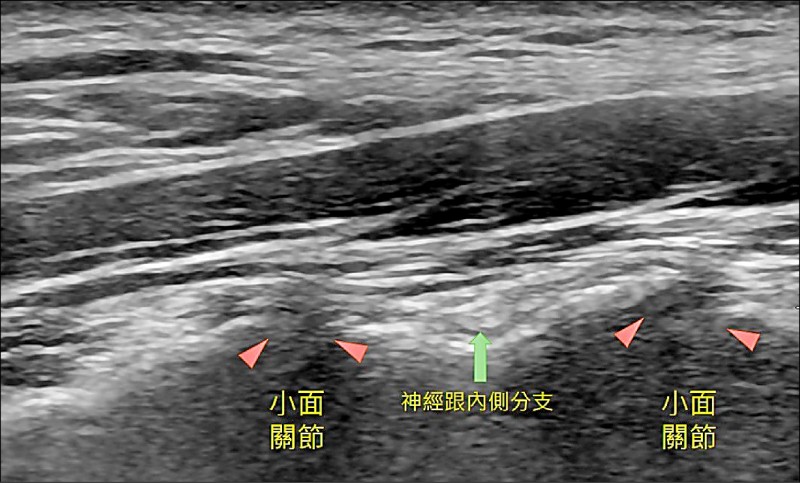 ▲圖1：橘色三角形是小面關節處。（照片提供／徐幼鈞）