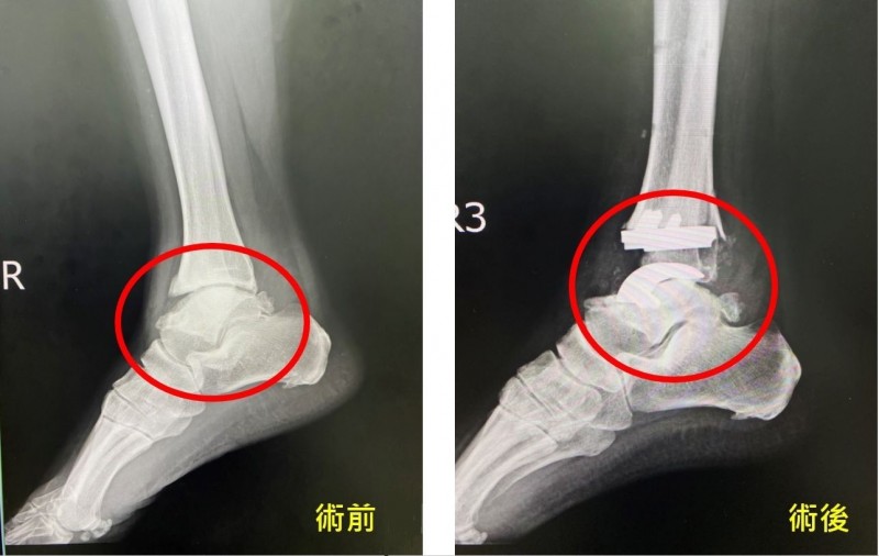 腳踝舊傷未治療變跛腳 全踝關節置換術 助恢復 即時新聞 自由健康網