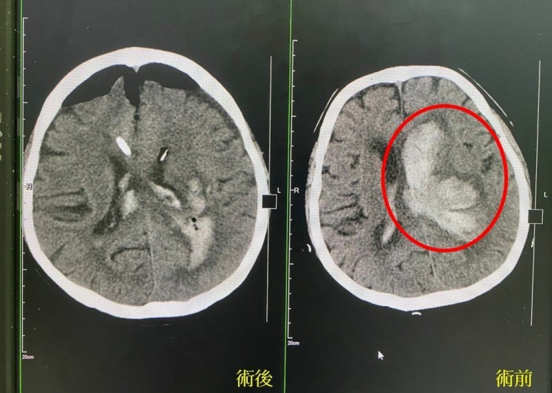 台中52歲陳姓男子便秘多日,解便用力過度竟腦出血(右紅圈處),經內視鏡微創手術順利清除血塊(左)恢復清醒。(記者陳建志翻攝) 3943610 2