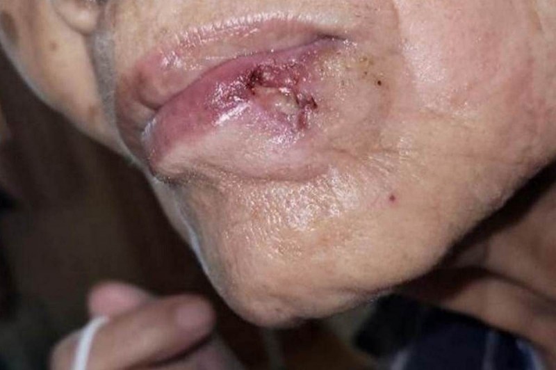 阿嬤的嘴角原先出現1顆褐黑色突起物,幾個月過去,這顆「痣」竟演變為潰瘍,擦藥也不見改善。(台北慈濟醫院提供) 3961867 1