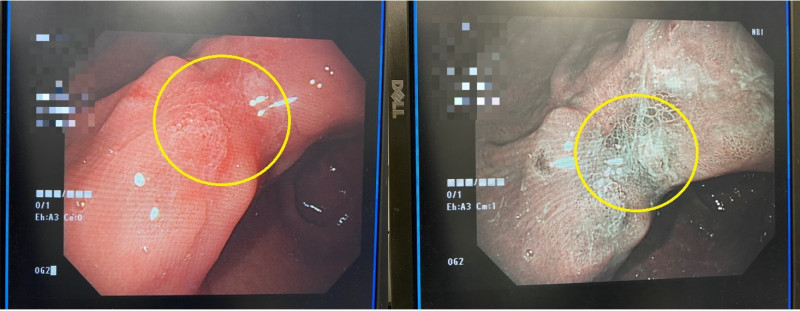 台中呂姓男子,接受NBI窄頻光波腸胃內視鏡檢查(右圖),可明顯發現不正常的細胞表現(黃圈處),2週後切片報告證實是胃腺癌。 (記者陳建志翻攝) 3990812 2