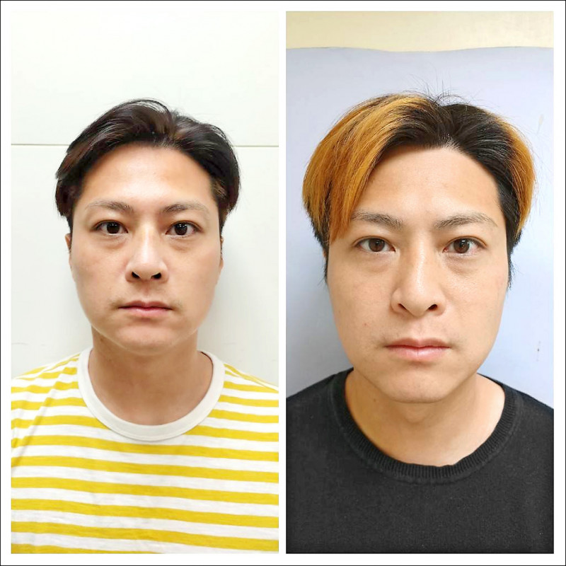▲陳先生治療前,鼻子塌陷(右),經醫師利用肋骨強而有力的特色,支撐山根和鼻頭,重建出適當鼻型(左)。(三總提供) 65