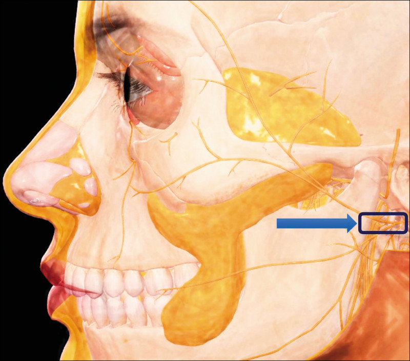 prominent-eyes-crooked-mouth-and-facial-nerve-palsy-may-not