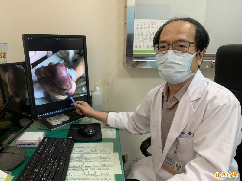 黃敏旭醫師說明,阿嬤用橡皮筋綁住大腳趾要止血,3小後就醫已經發紺腫脹,解下橡皮筋仍久久未消。(記者蔡淑媛翻攝) 4120523 4