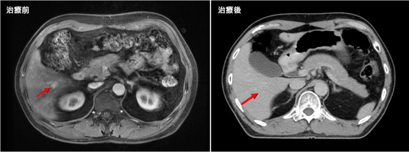 製茶老師傅經運用人工智慧身體立體定位放射治療5次，癌細胞已完成撲殺。（澄清醫院中港院區提供）