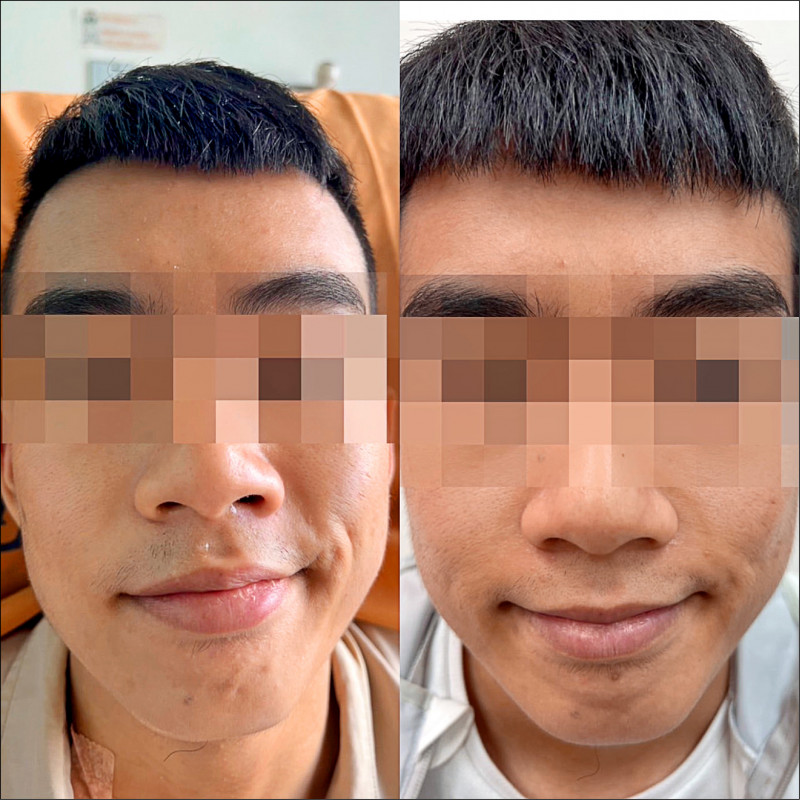▲男大生因車禍顳骨骨折導致右臉癱瘓無法做出表情(圖左),經顏面神經減壓手術2週後已不再嘴歪(圖右)。(小港醫院提供) 138