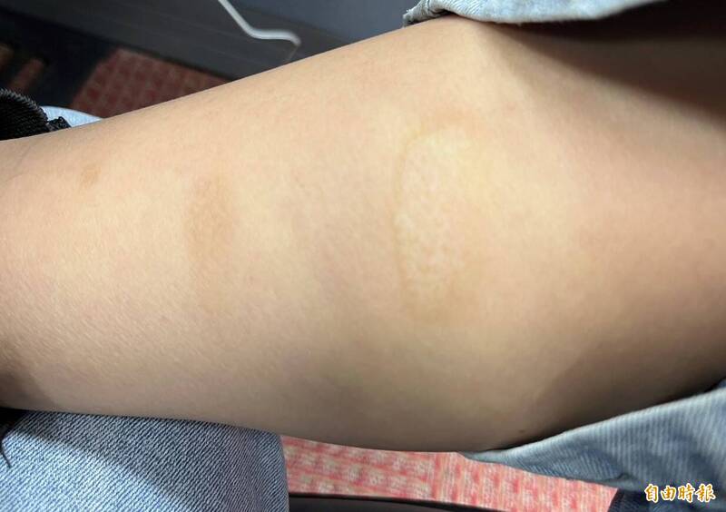 醫師表示，疤痕是皮膚受損、逐漸癒合後的必然結果。照護傷口時應維持患部乾淨、保持濕潤，也能適時使用除疤用品，且切記要防曬。（健康網攝）