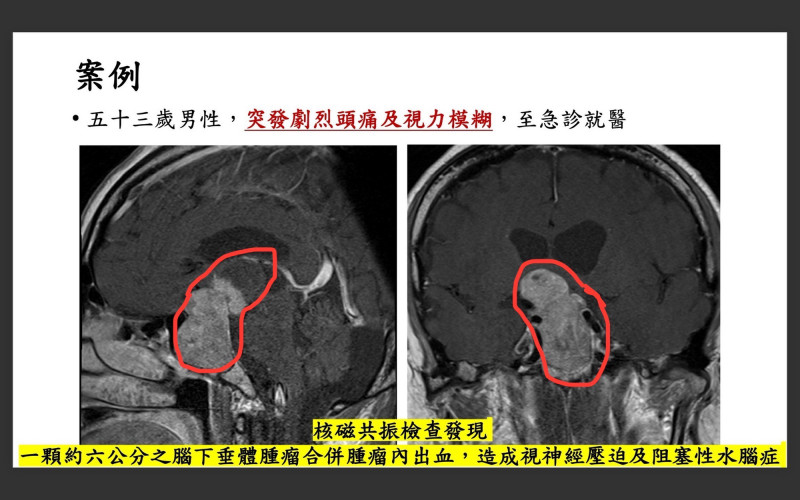 病患接受電腦斷層及核磁共振檢查，發現一顆約6公分的腦下垂體腫瘤合併腫瘤內出血。（台大醫院雲林分院提供）