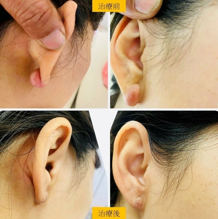 女穿耳洞竟長出「蟹足腫」？ 醫：避免不必要皮膚創傷 - 自由健康網