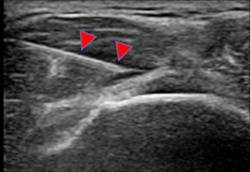 圖2:超音波導引下,進行肩膀肌腱注射治療(箭頭處為針尖)。(照片提供/曾文哲) 圖2:超音波導引下,進行肩膀肌腱注射治療(箭頭處為針尖)。(照片提供/曾文哲)
