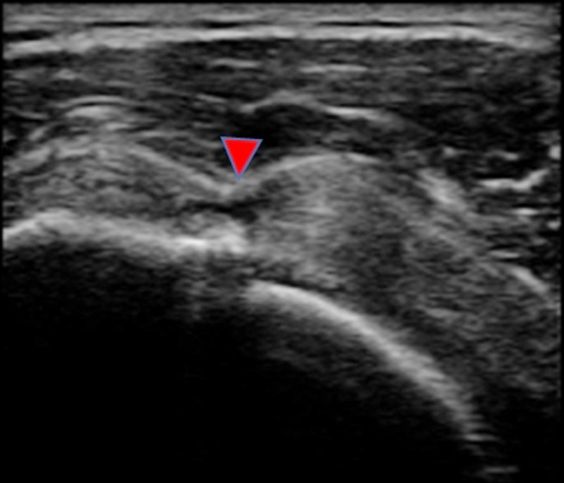 圖1:軟組織超音波顯示,肩膀肌腱有明顯撕裂情形(箭頭處)。(照片提供/曾文哲) 圖1:軟組織超音波顯示,肩膀肌腱有明顯撕裂情形(箭頭處)。(照片提供/曾文哲)