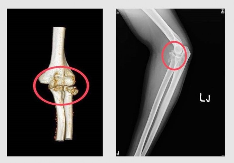 男大生車禍釀「手肘脫臼恐怖三聯症」 骨折固定、韌帶縫合助康復- 自由 