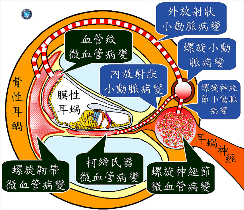 ▲圖2：血管病變侵犯耳蝸，引起聽障。（照片提供／陳建志）