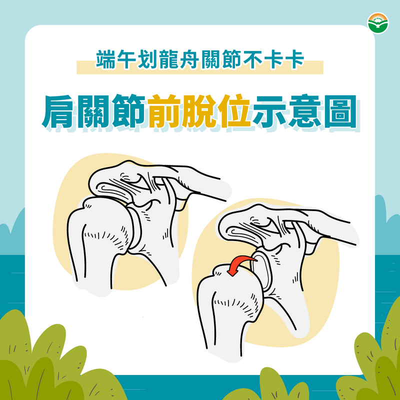 中醫師指出,肩膀的脫位9成以上是前脫位,為受到外力大力撞擊或拉扯造成的脫位。(馬光中醫診所提供)
