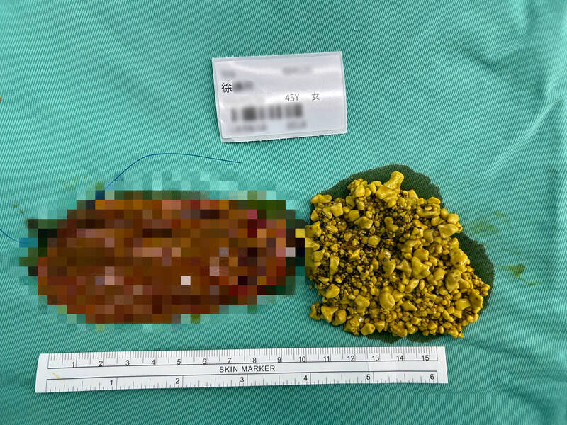 女工程師胃悶脹氣 一查竟是逾3000顆膽結石作祟