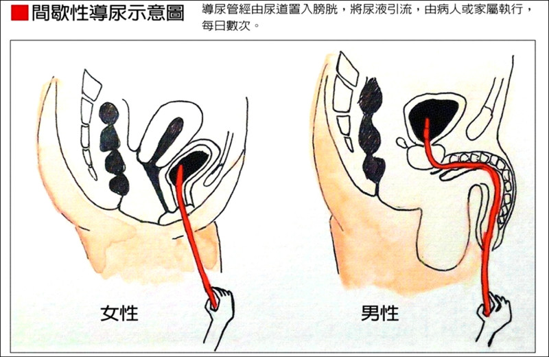 糖尿病婦膀胱無力 注射肉毒桿菌順暢排尿