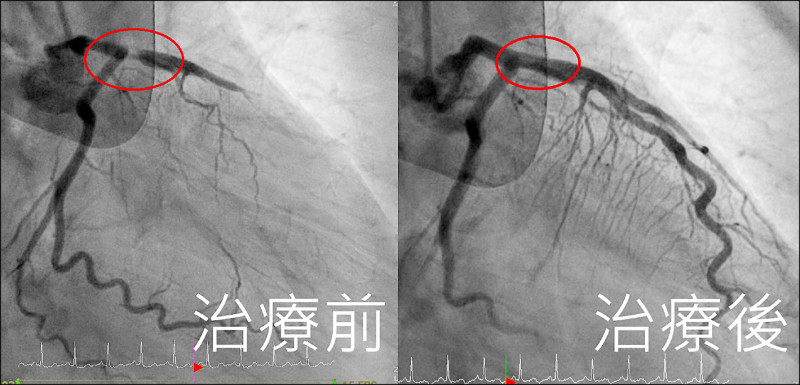 就醫突心肌梗塞 急裝支架通血管救命