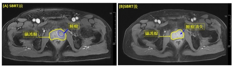 攝護腺癌新療法「立體定位放射治療」高精準度、低副作用