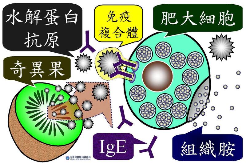 奇異果引發過敏機轉。水解蛋白酶抗原跟E型免疫球蛋白 （IgE）結合，免疫複合體跟巨大細胞結合，後者釋放出大量的組織胺。（陳建志提供）