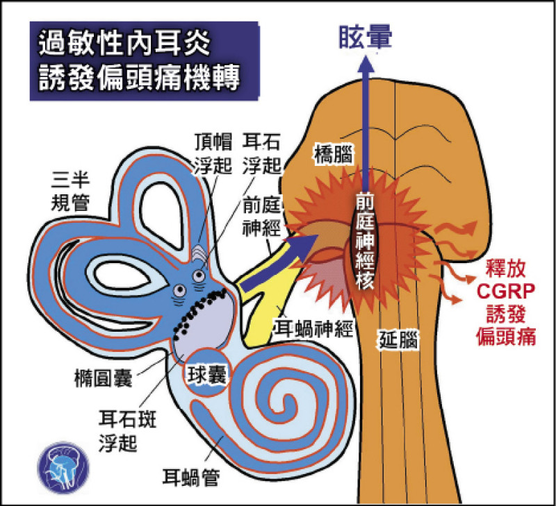 ▲過敏性內耳炎性偏頭痛的機轉。（照片提供／陳建志）