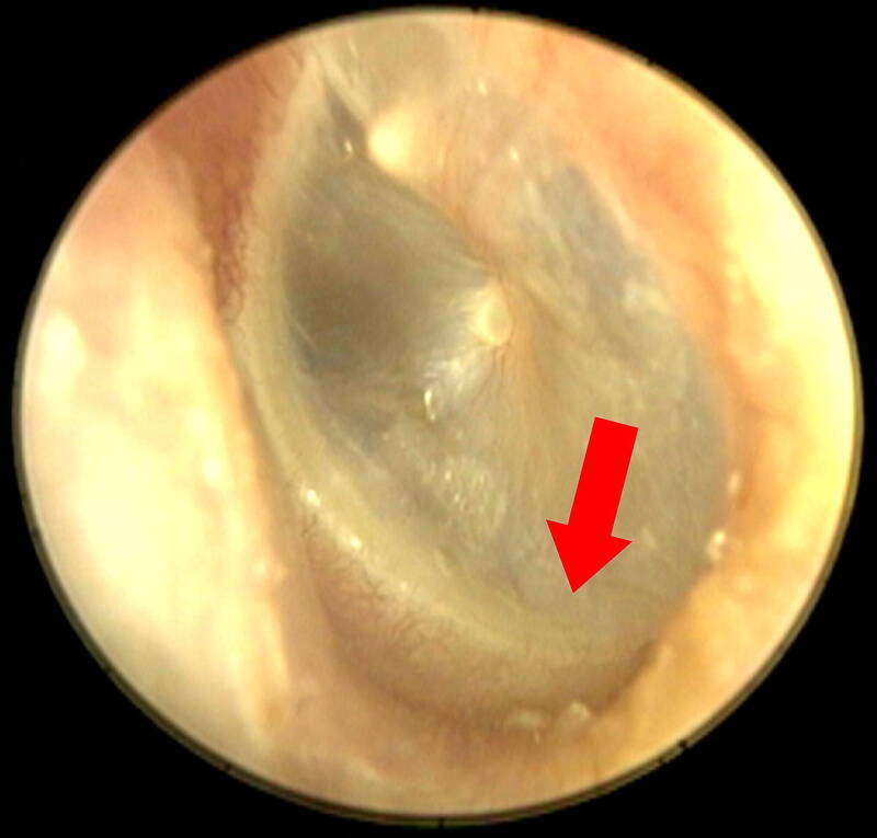 患者的耳膜下方，可以見到一層薄薄黃色的液面（箭頭所示）。（陳建志提供）