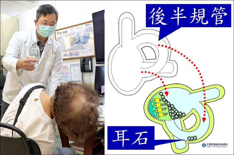 側身右傾竟「景物都在扭」耳石沉積症作怪