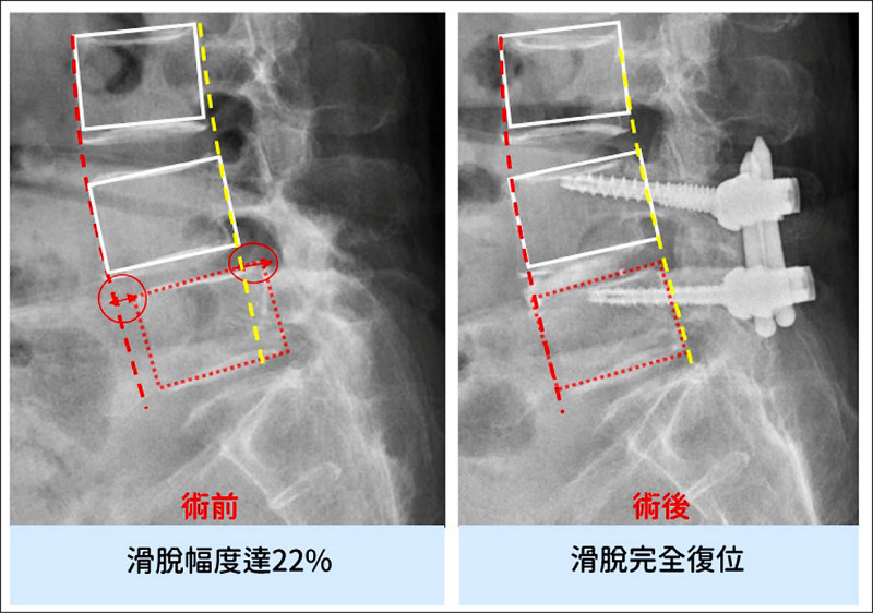 老人腰椎滑脫 「吊車技術」精準復位