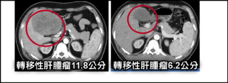 胃癌轉移肝 3管齊下助重獲生機