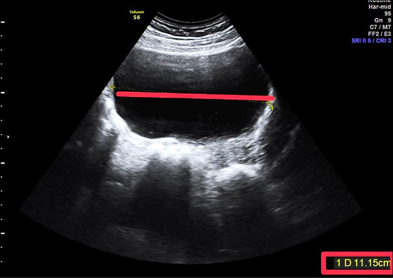 ▲婦人左側卵巢有顆11公分的巨大囊腫。(記者蔡淑媛翻攝) ▲婦人左側卵巢有顆11公分的巨大囊腫。(記者蔡淑媛翻攝)