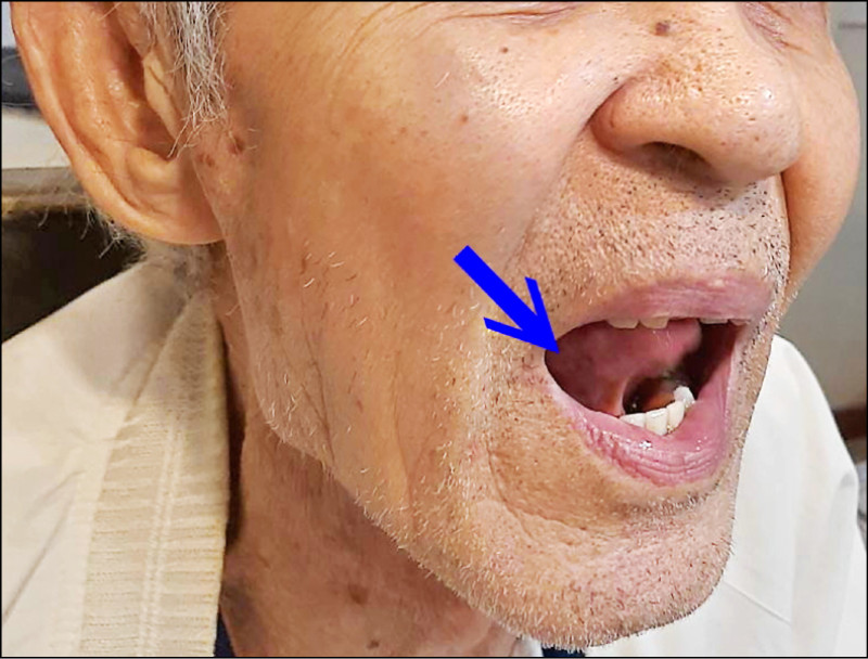 ▲圖2：箭頭所指為患者口腔潰瘍處。（照片提供／陳建志）