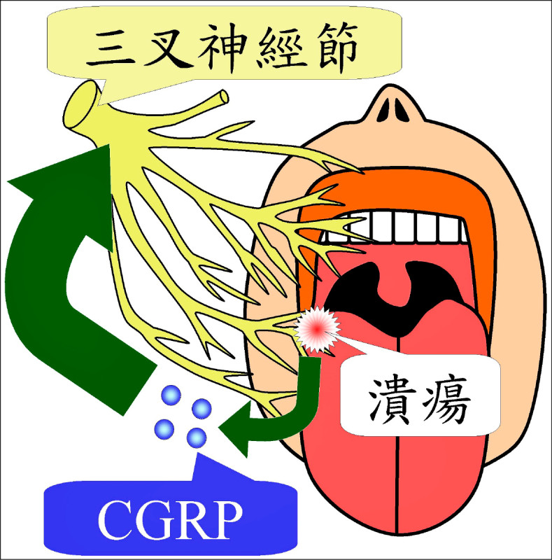 ▲圖3：口腔潰瘍處釋放出大量CGRP，活化三叉神經，誘發偏頭痛。（照片提供／陳建志）