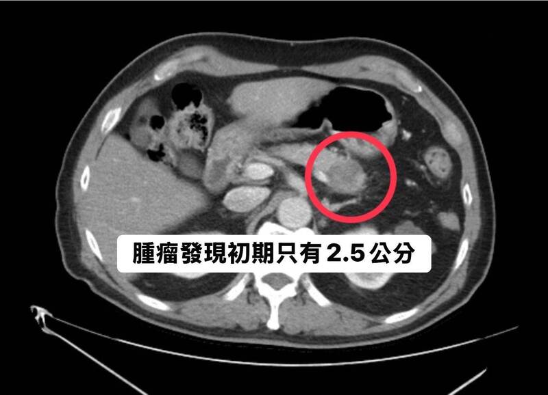 醫師分享個案，有患者做斷層掃描顯示胰臟有顆腫瘤，初期發現僅2.5公分。（圖擷取自胰林相宏臉書）