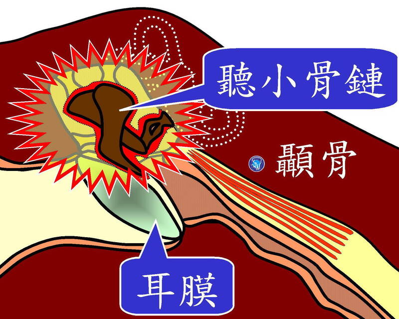 上鼓室中耳炎會侵犯聽小骨鏈。（陳建志提供）