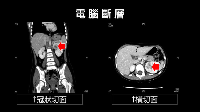 「上泌尿道」感染 6歲妹妹急性腎盂腎炎