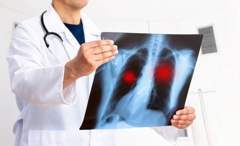 健康網》肺癌不是無聲殺手！ 國健署示警肺部「求救信號」