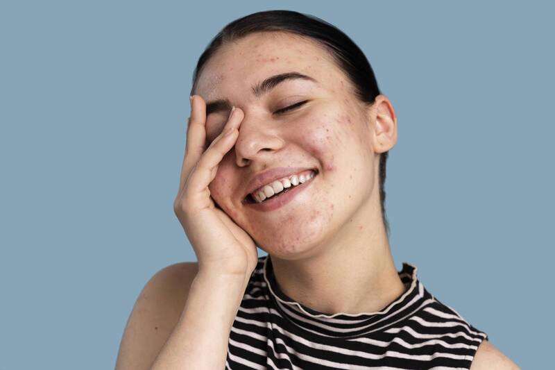 健康網》祛痘看體質 中藥面膜敷出好美肌