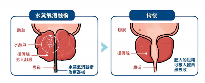 攝護腺水蒸氣微創消融手術治療原理。(長庚醫院提供) 攝護腺水蒸氣微創消融手術治療原理。(長庚醫院提供)