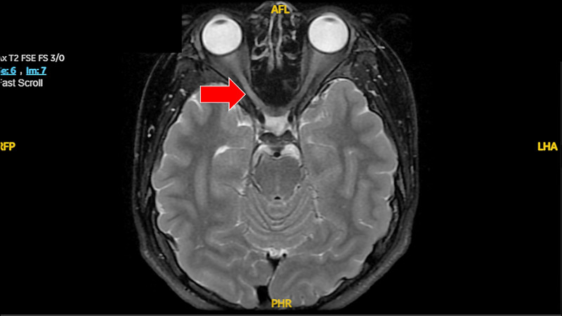 國中生視神經炎 視力急降到0.1