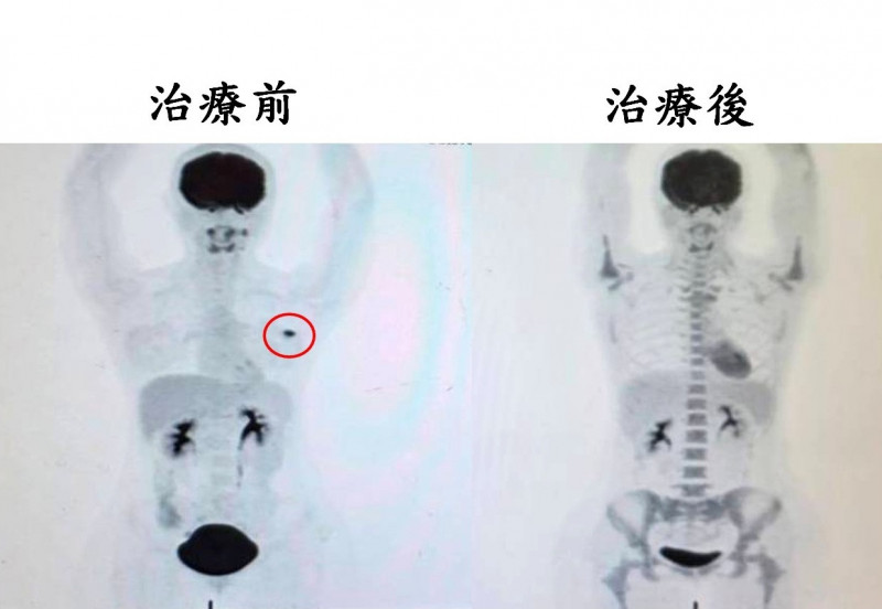 病人檢查發現有不規則腫瘤(紅圈處),經先期性化學治療及手術後,腫瘤細胞已完全消失。(苗栗市大千醫院提供) 病人檢查發現有不規則腫瘤(紅圈處),經先期性化學治療及手術後,腫瘤細胞已完全消失。(苗栗市大千醫院提供)