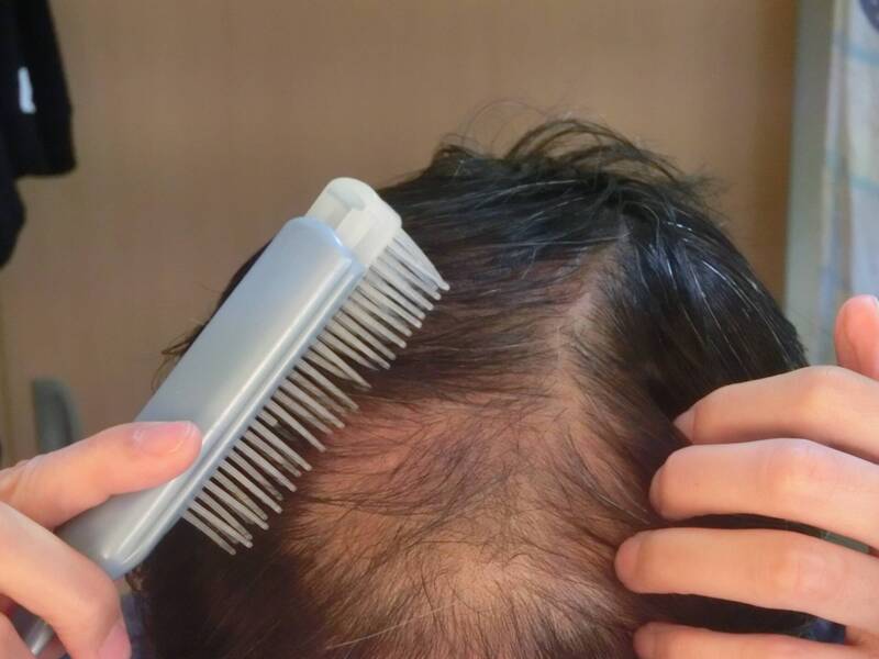 醫師提醒,在36歲前也可能發生早發性雄性禿,通常與代謝症候群有關。(圖取自PhotoAC) 醫師提醒,在36歲前也可能發生早發性雄性禿,通常與代謝症候群有關。(圖取自PhotoAC)