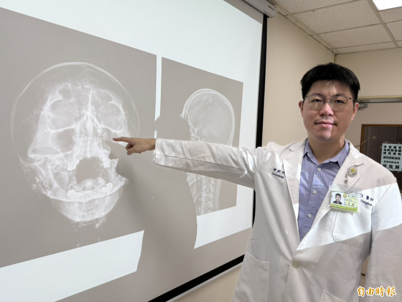 王星翰醫師指出,患者的左側鼻竇腫脹發炎,誘發偏頭痛。(記者蔡淑媛翻攝) 王星翰醫師指出,患者的左側鼻竇腫脹發炎,誘發偏頭痛。(記者蔡淑媛翻攝)