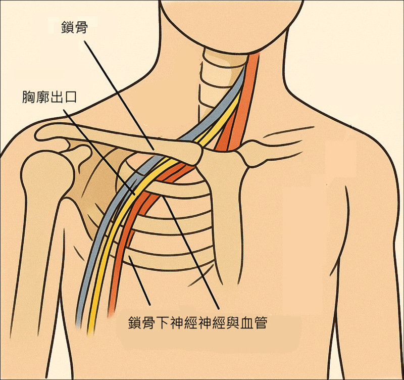 ▲圖1:胸廓出口(照片提供/楊辰竑) ▲圖1:胸廓出口(照片提供/楊辰竑)