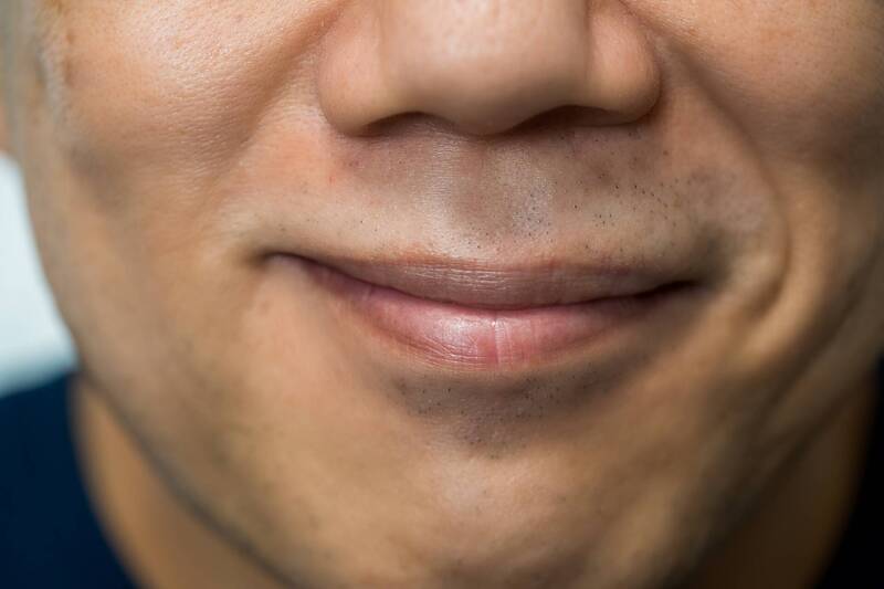 健康網》嘴唇長黃斑？醫談「福代斯斑點」：不是性病