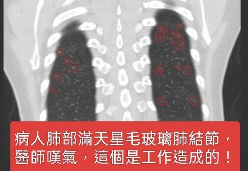 健康網》6旬婦肺部「滿天星」肺結節 蘇一峰嘆「這工作」造成
